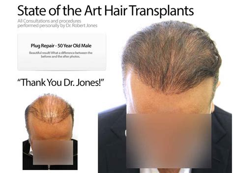 Plug Repair - 50 YO male - Hair Transplant | Dr.Robert Jones