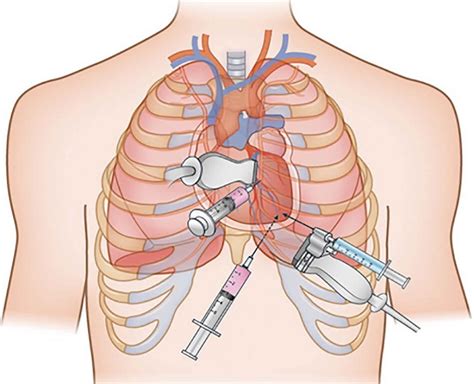 Pericardial Window Procedure Steps