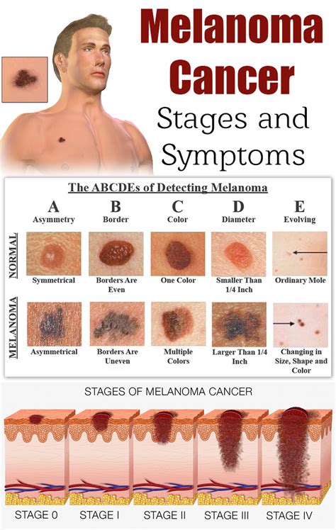 Signs Of Melanoma Skin Cancer
