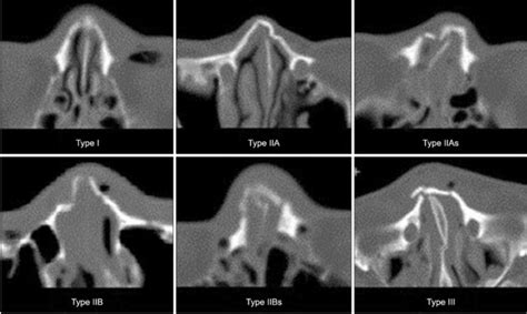 nose - NASAL BONE FRACTURE - Dr. Meenesh Juvekar - ENT Specialist