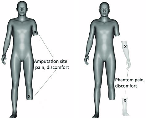 avatar representation of residual limb and phantom limb pain in amputees. | Download Scientific ...