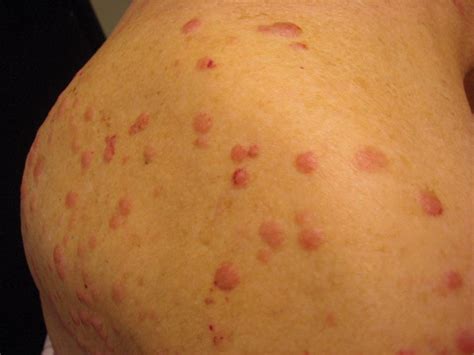 Multiple Firm Pink Papules and Nodules | MDedge Dermatology