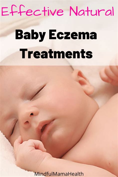 Safe and Effective Baby Eczema Natural Remedies | Baby eczema, Baby eczema treatment, Natural ...