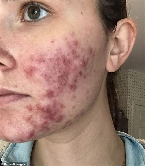 Stylist, 23, with severe cystic acne goes out without makeup for the FIRST TIME | Daily Mail Online