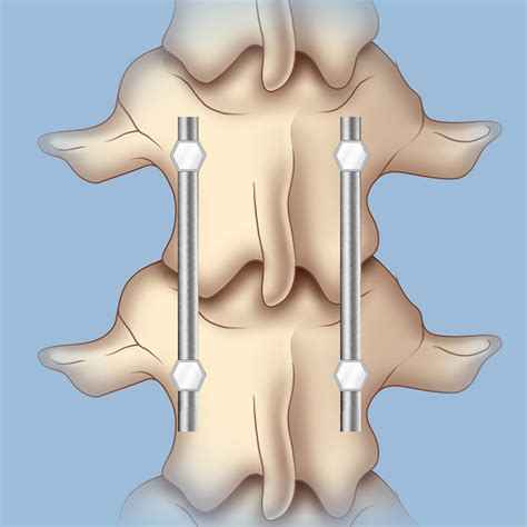 Surgery for Spinal Compression Fractures | Weill Cornell Brain and ...