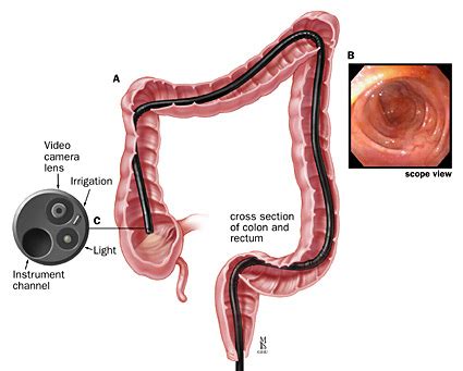 Colonoscopy