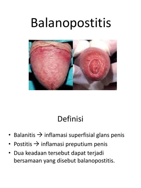 Balanopostitis