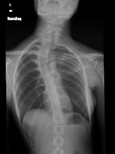 Cureus | Sprengel’s Deformity With Congenital Scoliosis Successfully Treated With Combined ...