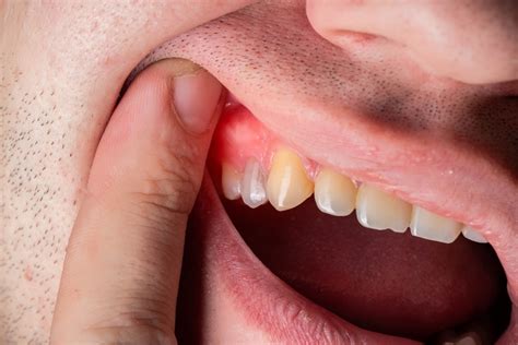 Understanding Dental Abscess | Concierge Dental