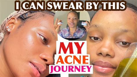 5 Chemical Exfoliant That Has Helped My Oily Skin/ Acne On My Skincare Journey - YouTube