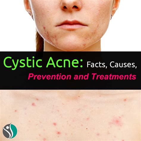 Cystic Acne: Facts, Causes, Prevention, and Treatments %% - ConsumerHealthWeekly.com