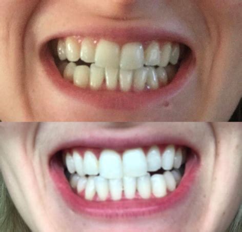 MakeupDownUnder: Crest 3D Whitestrips Vivid: Before After,, 59% OFF