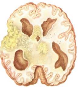 What Is Tuberculous Meningitis;Diagnosis,Treatment,Prevention