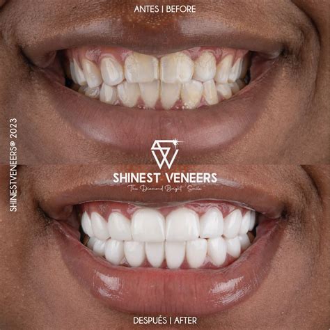 Veneers – Porcelain smile design – Porcelain veneers