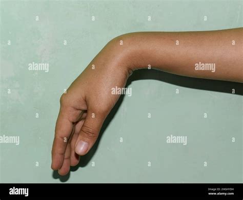 Radial nerve injury or wrist drop of Asian young woman Stock Photo - Alamy