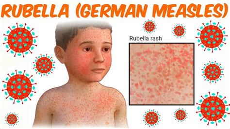 German Measles Vs Measles