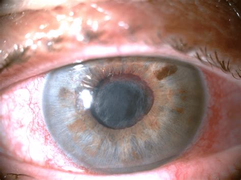 7: Pathological angiogenesis in the iris tissue-rubeosis iridis ...