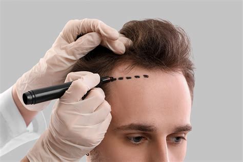 Choosing a Hair Transplant Clinic - Hair Doctors