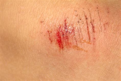 3 tips to avoid infections in simple cuts and scrapes