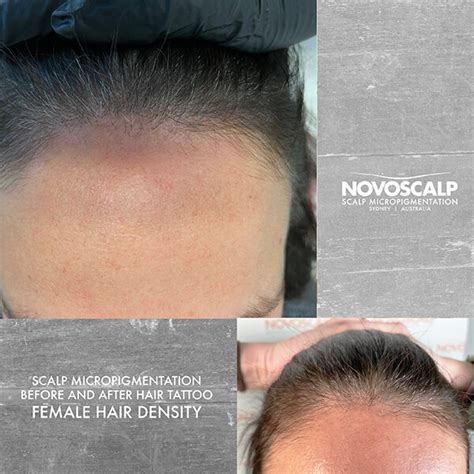 Scalp micropigmentation before and after female hairline tattoo sydney - Novoscalp | SMP Clinics ...