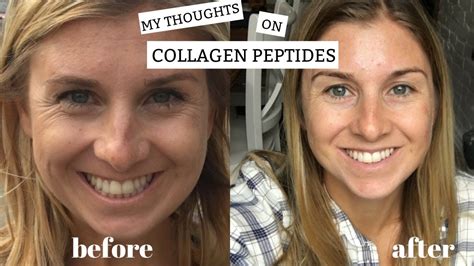 Mothlhtqqjbpqdp: Collagen Powder Before And After Pics