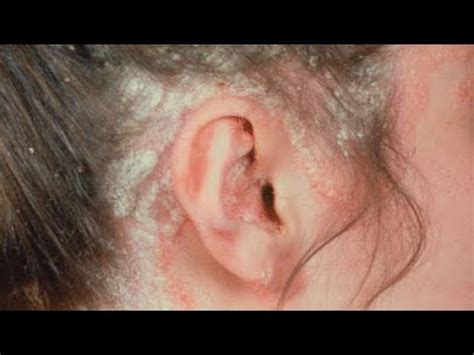 How To Treat Psoriasis Of The Ear / Ear Psoriasis - YouTube