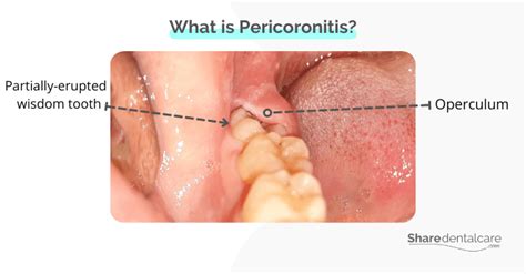 Pericoronitis Smell: Causes of Bad Breath & Treatments - Share Dental Care