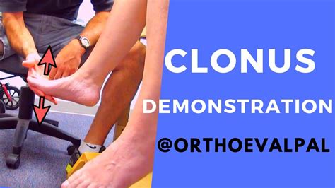 Clonus Demonstration with Ortho Eva Pal - YouTube