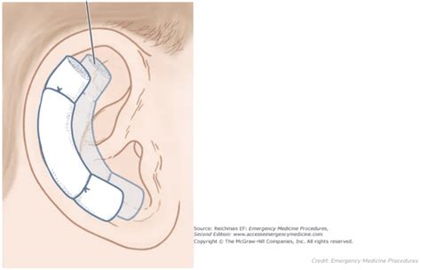 Auricular Hematoma Management - REBEL EM - Emergency Medicine Blog