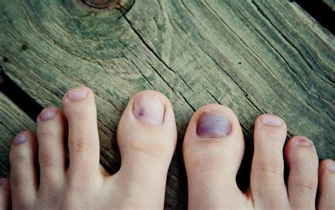 Bruised Toenail From Running? What To Do About Runner's Toe