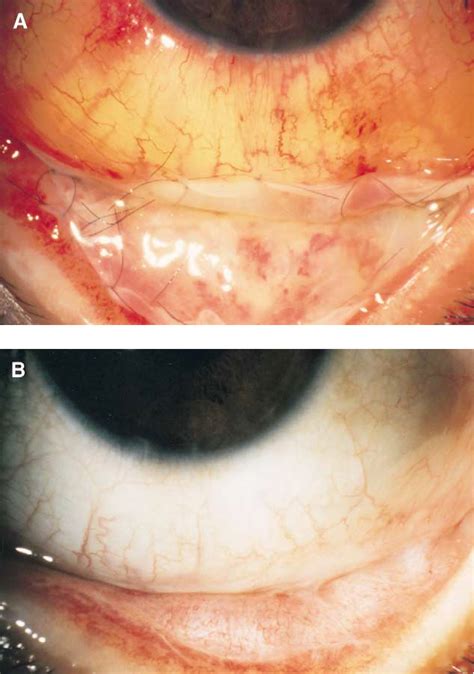 Figure 2 from Fornix and conjunctiva reconstruction by amniotic membrane in a patient with ...