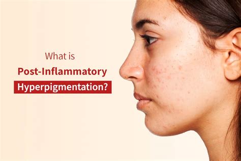 What is Post-Inflammatory Hyperpigmentation?