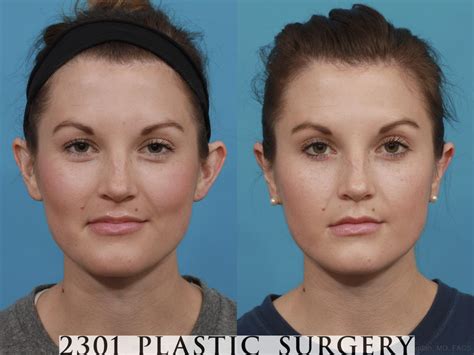 Ear Surgery Otoplasty for Fort Worth, Frisco & Plano, TX – 2301 Plastic ...