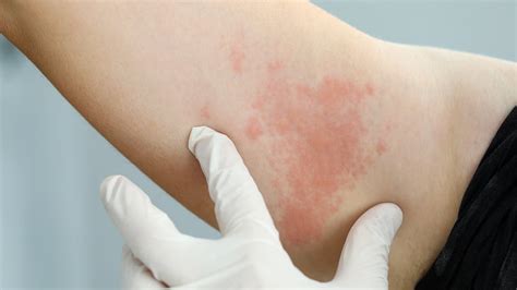 Urticaria Treatment