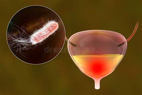 Cystitis, Bacterial Infection of Urinary Bladder Stock Illustration - Illustration of urine ...