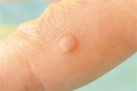 11 effective natural ways to get rid of irritating warts | Better Homes and Gardens