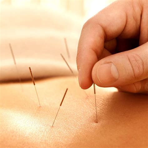 Acupuncture Pinpoints Real Pain Relief