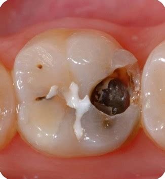 Recurrent Caries Causes, Treatments, and Prevention | Dentsply Sirona USA