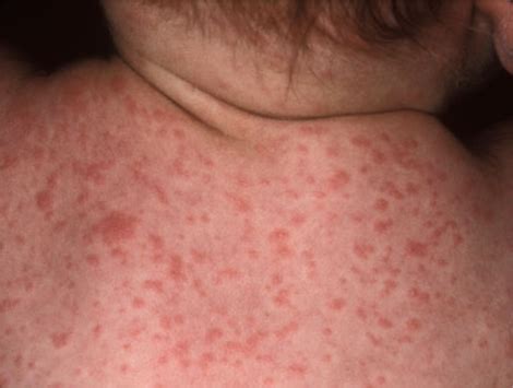 Viral Exanthem Rash Baby