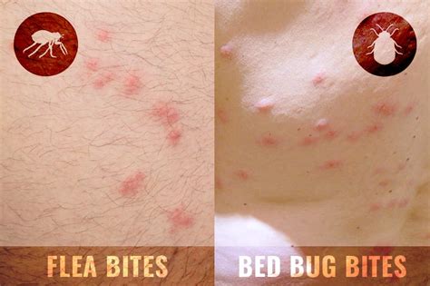 essbar Routine Beruhigen difference between flea and bed bug bites Auckland emotional Geizhals