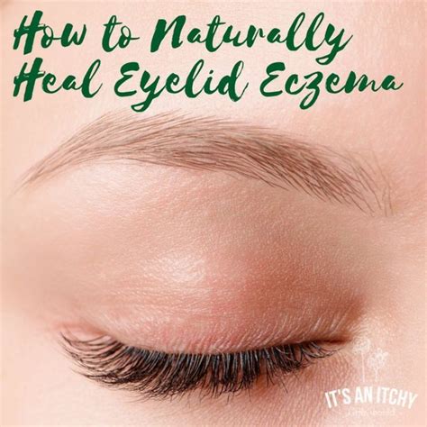 How to Naturally Heal Eyelid Eczema | It's an Itchy Little World ...