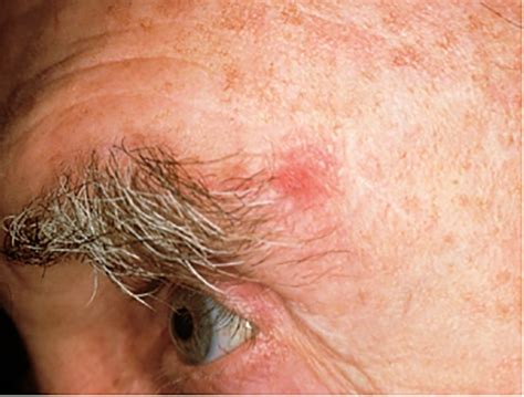 Basal Cell Skin Cancer On Nose – Cancer Symptom