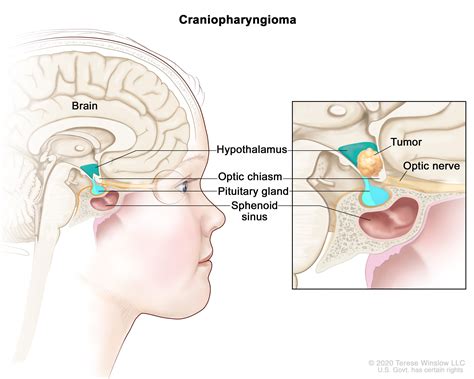 Childhood Craniopharyngioma Treatment - NCI