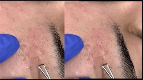 Pimple Popping Videos 2024 Blackheads Removal Youtube - Lina Shelby