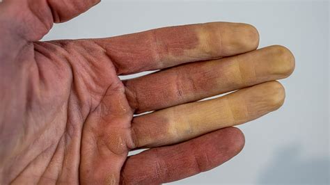 Fingers Turn Blue or White When Cold? It Could be Raynaud’s ...