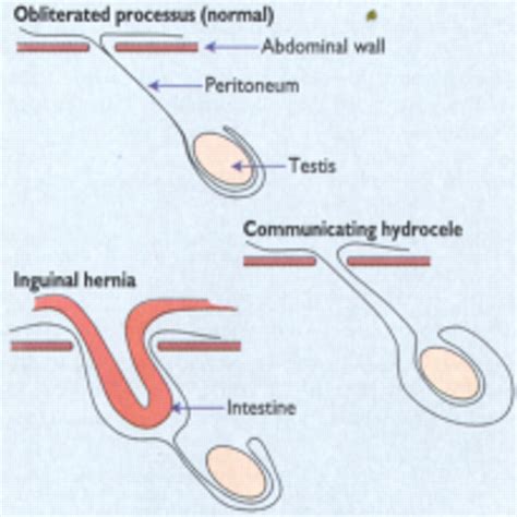 ABC of General Paediatric Surgery: INGUINAL HERNIA, HYDROCELE, AND THE UNDESCENDED TESTIS | The BMJ