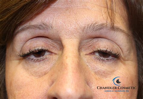 Ptosis Repair (Eyelid lift) for Droopy Eyelids - Chandler Cosmetic