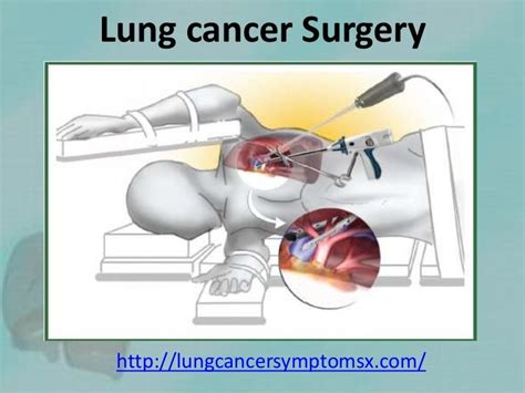 Lung cancer surgery