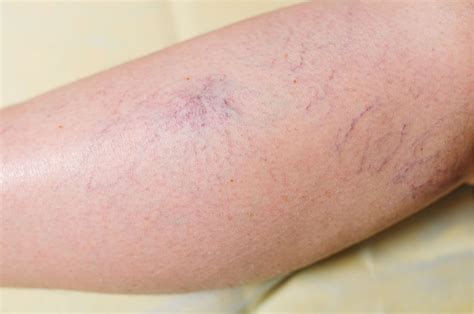 UK Vein Clinic | Blog | How To Prevent Spider Veins