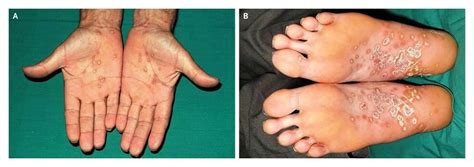 Keratoderma blenorhagicum